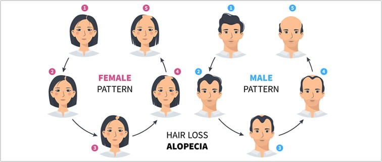 Hairloss, Male and Female patterns